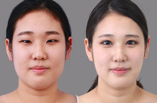 Modalities Of Eyelid Surgery