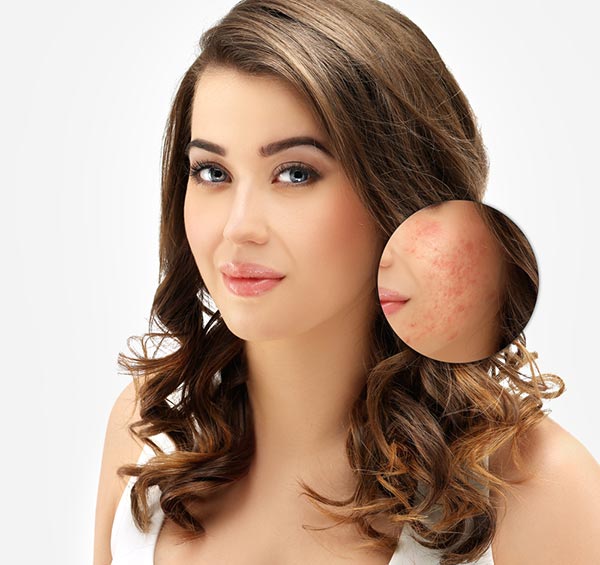 Get Rid Of The Unwanted Acne: 5 Easy Solutions