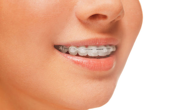 Adult Braces: Why You Should Go For Them