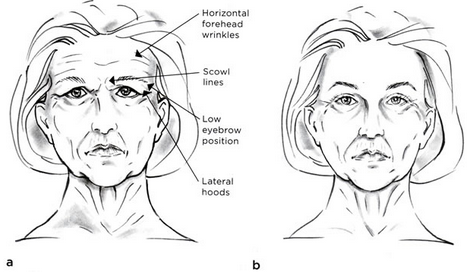 Browlift