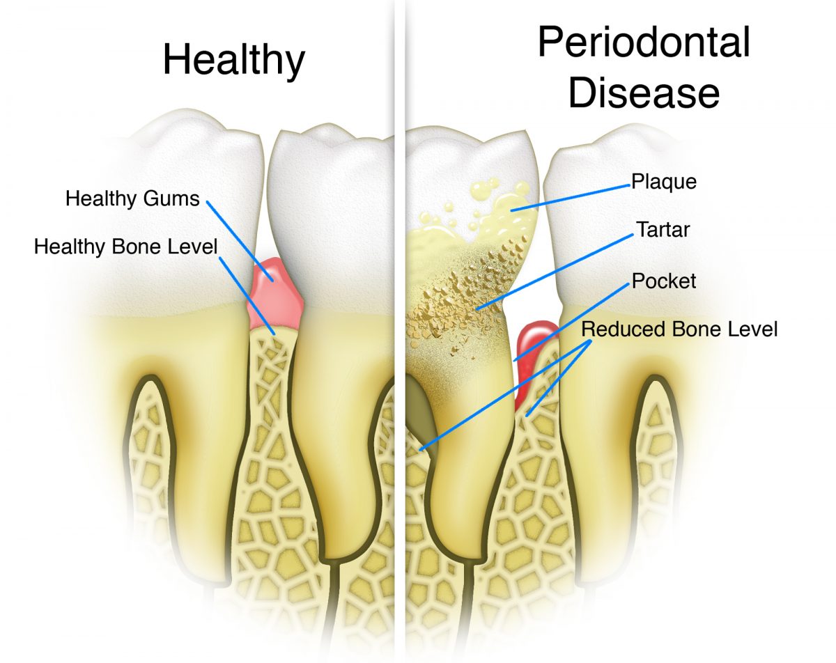 6 Ways Stress Affects Your Oral Health