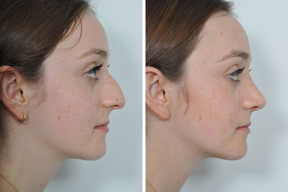 The Latest Trend In Rhinoplasty In Dubai