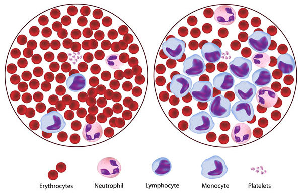 How Leukaemia Is Treated With A Lot Of Precision And Care?