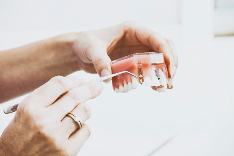 4 Things You Should Know Before Getting A Dental Implant