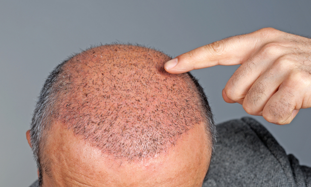 Hair Transplant: Myth vs Reality